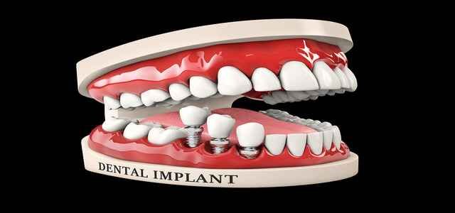 Dental and Bone Complications