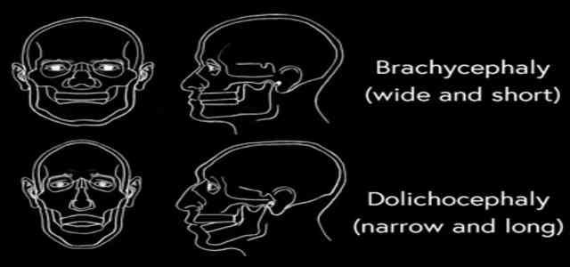 Dolichocephaly Long Narrow Skull