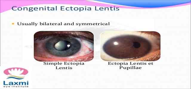 Ectopia Lentis