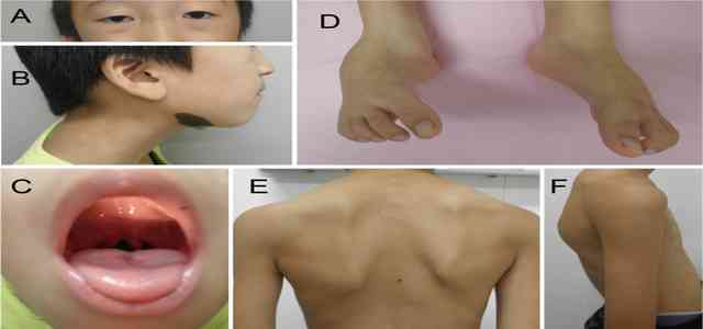 How Does Marfan Syndrome Affect the Skin