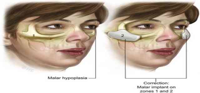 Malar Hypoplasia Flat Cheek bones