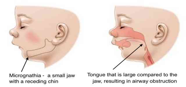 Micrognathia Small Jaw