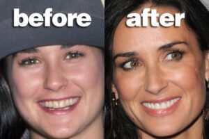 Famous Actresses Fake Teeth Demi Moore