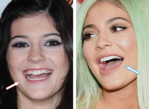 Famous Models Teeth Implants Kylie Jenner