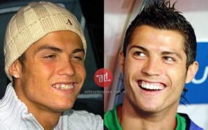 Famous Players Teeth Implants Cristiano Ronaldo