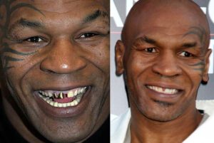 Famous Players Teeth Implants Mike Tyson