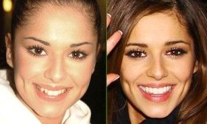 Famous Singers Teeth Implants Cheryl Cole