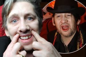 Famous Singers Teeth Implants Shane MacGowan