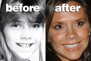 Famous Singers Teeth Implants Victoria Beckham