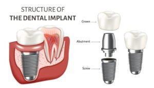 What is a Dental Implant