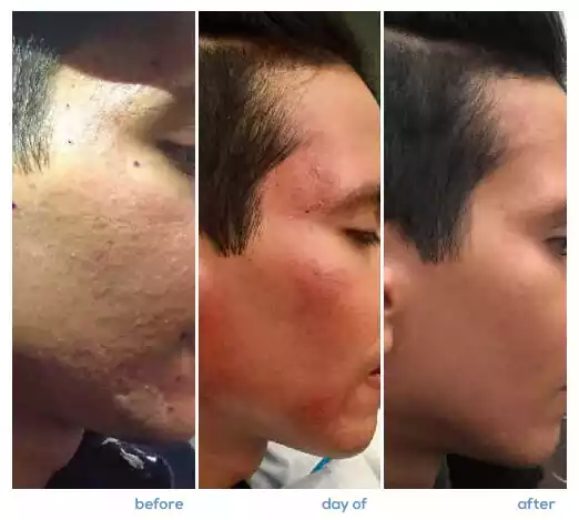 Microneedling-before-and-after