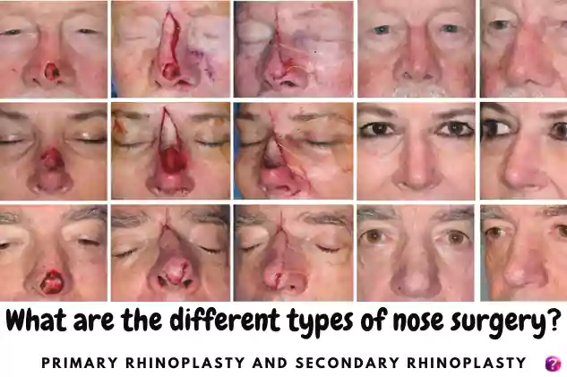 different types of nose surgery